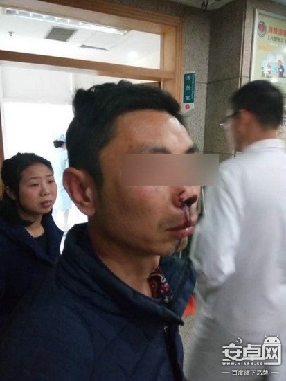 快遞員遭暴打致鼻梁骨折臉部血腫 因要求快遞員實名簽收